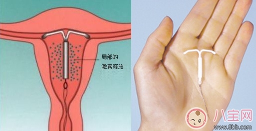 哪種避孕環(huán)比較好 避孕環(huán)存在哪些副作用 哪種避孕環(huán)比較好 避孕環(huán)存在哪些副作用