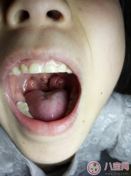 孩子扁桃體炎反復可以切了嗎 孩子經(jīng)常得扁桃體炎怎么辦 孩子扁桃體炎反復可以切了嗎 孩子經(jīng)常得扁桃體炎怎么辦