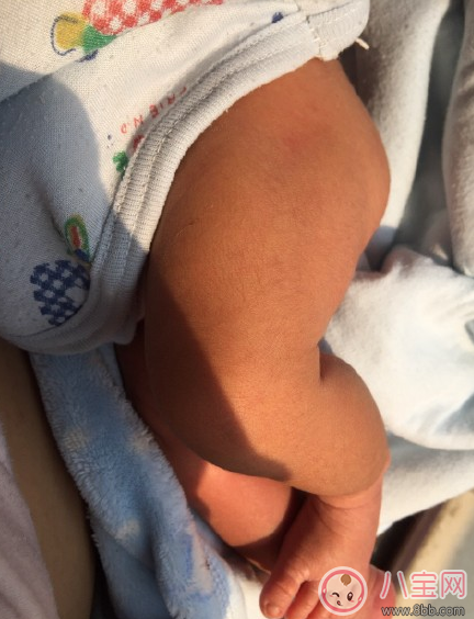 孩子黃疸曬太陽曬多久 寶寶黃疸曬太陽怎么曬好