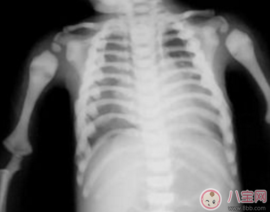 石骨癥是什么 石骨癥可以治愈嗎 石骨癥是什么 石骨癥可以治愈嗎