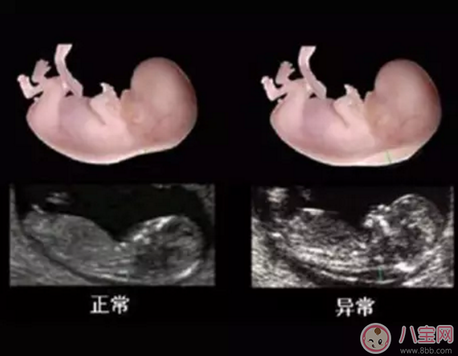 唐氏篩查準確率高不高 唐篩和nt哪個準確率高 唐氏篩查準確率高不高 唐篩和nt哪個準確率高