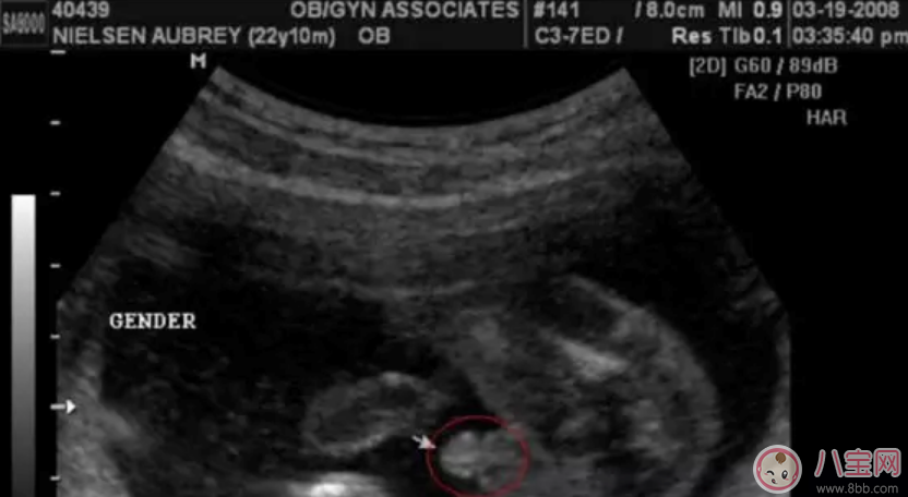B超怎么看男女 如何通過(guò)四維彩超圖看生男生女