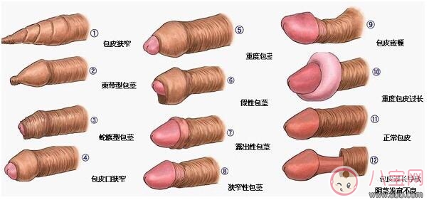 包皮過長會影響性生活嗎 包皮過長有哪些影響 包皮過長會影響性生活嗎 包皮過長有哪些影響