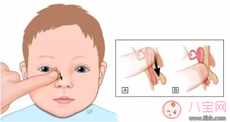 新生兒淚囊炎是什么病 孩子的眼屎應該怎么清理比較好 新生兒淚囊炎是什么病 孩子的眼屎應該怎么清理比較好