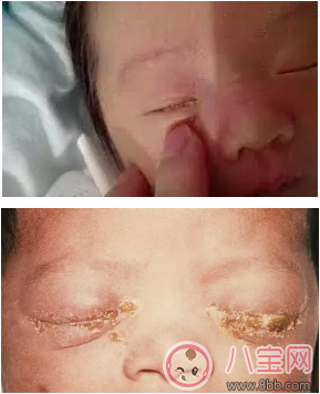 新生兒淚囊炎是什么病 孩子的眼屎應該怎么清理比較好 新生兒淚囊炎是什么病 孩子的眼屎應該怎么清理比較好