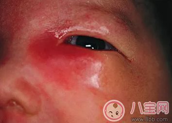新生兒淚囊炎是什么病 孩子的眼屎應該怎么清理比較好 新生兒淚囊炎是什么病 孩子的眼屎應該怎么清理比較好