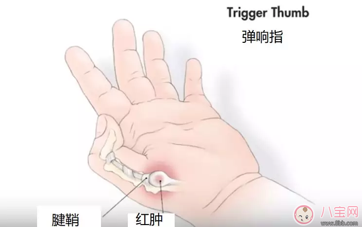 孩子手指伸不直是什么情況，為什么孩子的手指伸不直