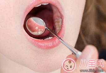 孕婦能用口腔潰瘍散嗎 孕婦口腔潰瘍小妙招