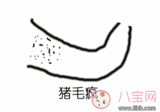 孩子身上長豬毛風是什么原因 孩子長了豬毛風要怎么治療 孩子身上長豬毛風是什么原因 孩子長了豬毛風要怎么治療