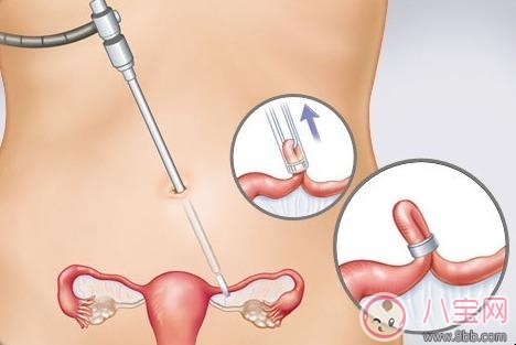 2018最新的避孕方法有哪些 2018避孕方法哪種成功率最高