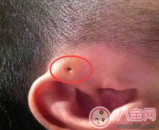 寶寶耳朵上有個小洞是怎么回事 寶寶耳朵上的小洞是遺傳嗎