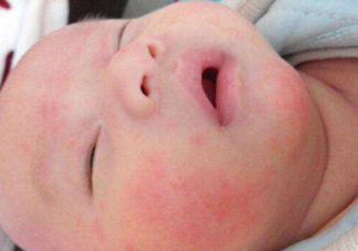 寶寶濕疹怎么預防2018 寶寶濕疹三大預防措施