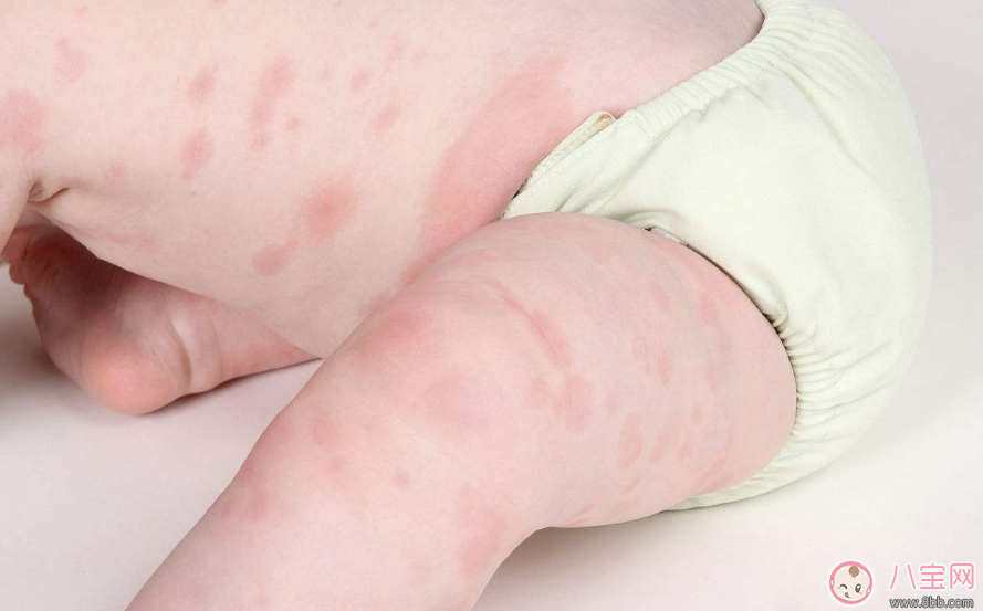 寶寶吃阿莫西林過敏癥狀 2歲寶寶服用阿莫西林過敏怎么辦 