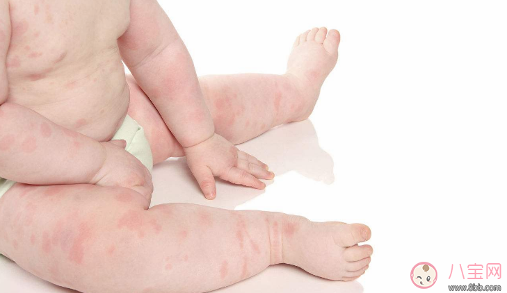 寶寶吃阿莫西林過敏癥狀 2歲寶寶服用阿莫西林過敏怎么辦 