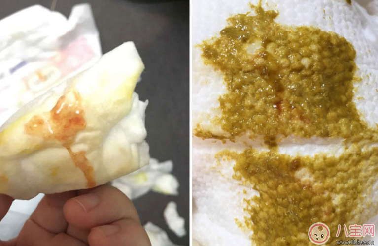 母乳過敏怎么辦2018 母乳過敏的癥狀有哪些 母乳過敏怎么辦2018 母乳過敏的癥狀有哪些