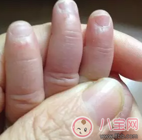 寶寶手指長倒刺是缺鋅嗎 寶寶長倒刺是缺少什么營養呢 寶寶手指長倒刺是缺鋅嗎 寶寶長倒刺是缺少什么營養呢