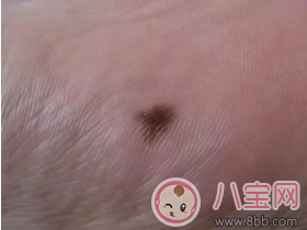 孩子長痣要去去掉嗎 孩子長哪些痣需要給去掉