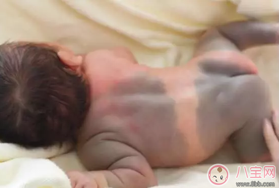 孩子長胎記是好還是壞 孩子身上有哪些胎記要去治療 孩子長胎記是好還是壞 孩子身上有哪些胎記要去治療