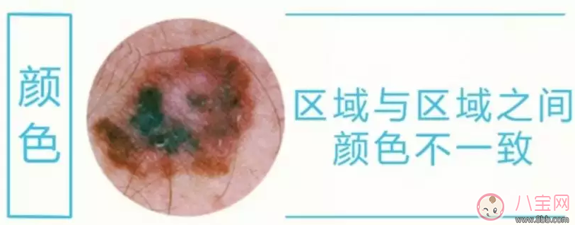 孩子長痣要去去掉嗎 孩子長哪些痣需要給去掉