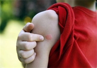 孩子突發(fā)蕁麻疹怎么止癢 孩子突發(fā)蕁麻疹的正確做法