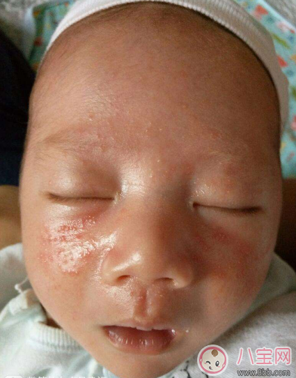 孩子突發蕁麻疹怎么辦 孩子起大片大片的疙瘩怎么辦