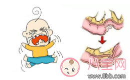 孩子突然肚子痛是腸套疊嗎 孩子腸套疊怎么辦