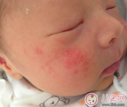 寶寶春季濕疹反復怎么辦 怎樣有效預防寶寶濕疹