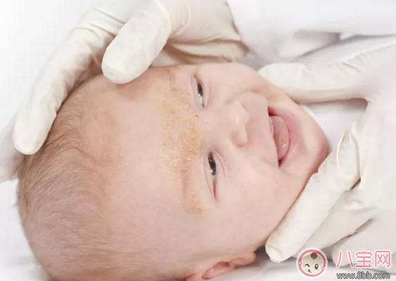 寶寶春季濕疹反復怎么辦 怎樣有效預防寶寶濕疹