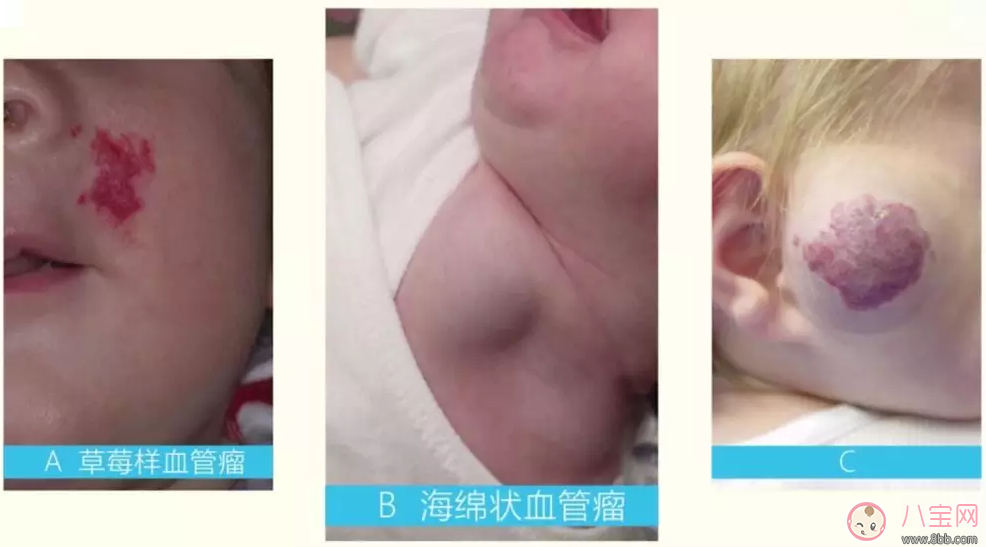 寶寶身上的紅印子是什么東西 孩子身上長紅色的塊狀東西是什么