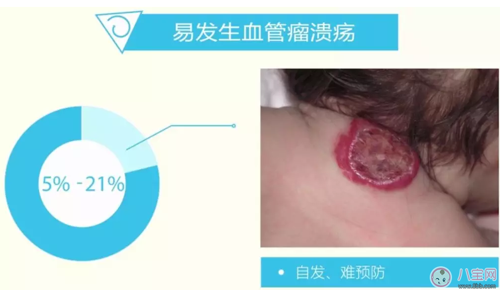 寶寶身上的紅印子是什么東西 孩子身上長紅色的塊狀東西是什么