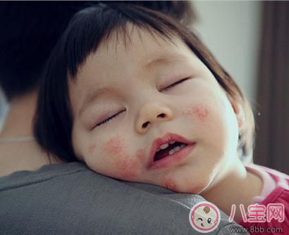 寶寶春天臉上起紅疙瘩怎么回事 寶寶起紅疙瘩是過敏嗎 寶寶春天臉上起紅疙瘩怎么回事 寶寶起紅疙瘩是過敏嗎