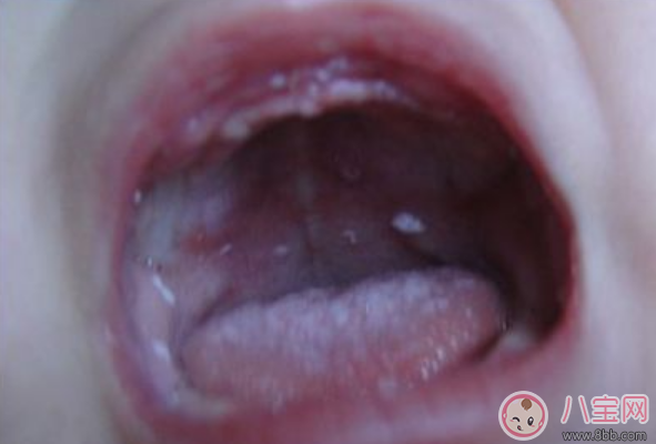 寶寶春天更容易長鵝口瘡嗎 春天寶寶長鵝口瘡吃什么好