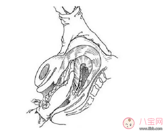 手剝胎盤沒有干凈癥狀是什么 手剝胎盤沒有干凈會(huì)有哪些影響