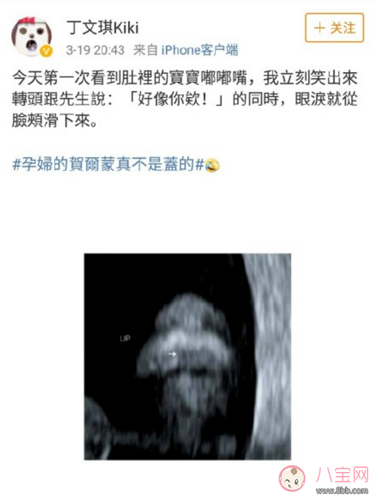 丁文琪B超照寶寶嘴唇像林宥嘉 B超寶寶長(zhǎng)相和生下來(lái)有區(qū)別嗎