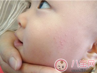 寶寶得了濕疹可以打疫苗嗎 寶寶濕疹怎么護(hù)理好 寶寶得了濕疹可以打疫苗嗎 寶寶濕疹怎么護(hù)理好