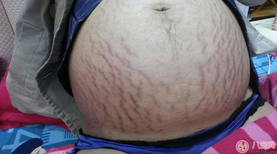 妊娠紋怎樣才能消除 減輕妊娠紋的方法是什么