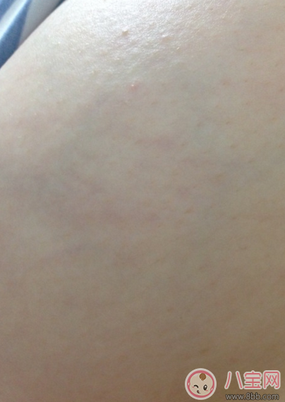 妊娠紋前兆是紅點點嗎 妊娠紋是長什么樣子初期圖片