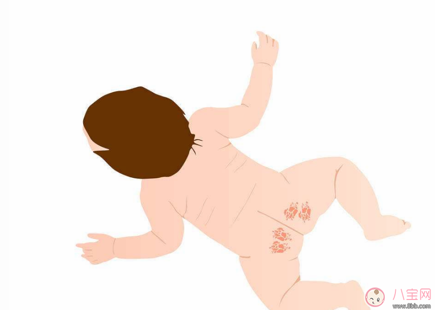 寶寶尿布疹什么樣子 新生嬰兒得了尿布疹怎么辦
