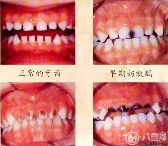 寶寶奶瓶齲的危害有哪些 寶寶奶瓶齲怎么預防2018 寶寶奶瓶齲的危害有哪些 寶寶奶瓶齲怎么預防2018