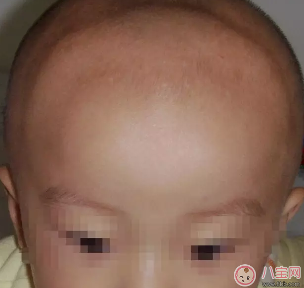 小孩方顱是什么原因 小孩方顱有哪些治療方法