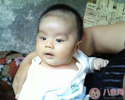 小孩方顱是什么原因 小孩方顱有哪些治療方法