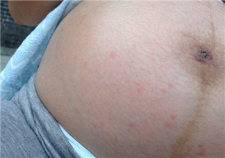 妊娠紋前兆是紅點點嗎 妊娠紋是長什么樣子初期圖片