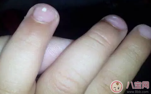 寶寶指甲上有白色斑點怎么回事 小孩指甲上有白色斑點是什么病 寶寶指甲上有白色斑點怎么回事 小孩指甲上有白色斑點是什么病