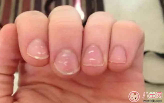 寶寶指甲上有白色斑點怎么回事 小孩指甲上有白色斑點是什么病 寶寶指甲上有白色斑點怎么回事 小孩指甲上有白色斑點是什么病