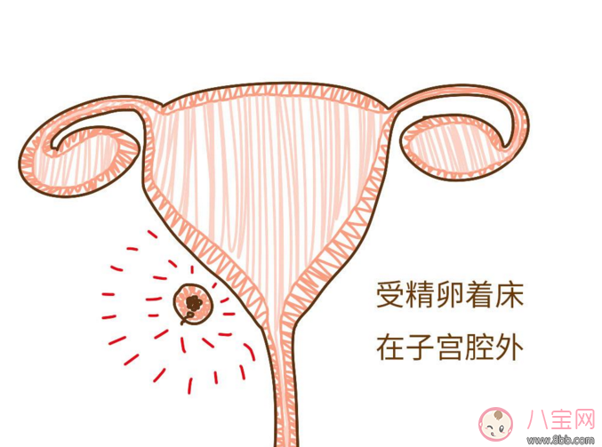 宮外孕試紙能測出來嗎 宮外孕有哪些癥狀