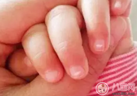 寶寶指甲上有白色的橫線怎么辦 寶寶指甲白色橫線吃什么好 寶寶指甲上有白色的橫線怎么辦 寶寶指甲白色橫線吃什么好