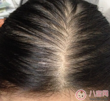 產(chǎn)后脫發(fā)會(huì)持續(xù)多久 為什么產(chǎn)后脫發(fā)嚴(yán)重