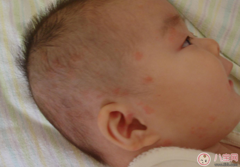 小孩濕疹反復怎么辦 濕疹為什么會反復發作