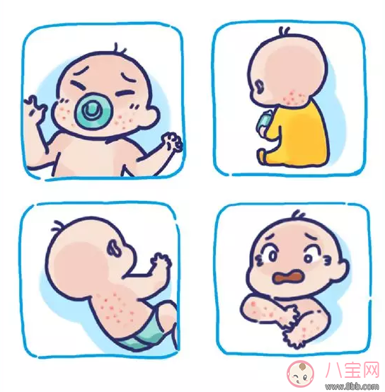 孩子濕疹癥狀反復不好怎么辦 孩子濕疹治療方法分享