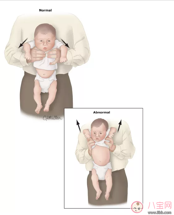 孩子頭總往后仰是腦癱的前奏嗎 孩子喜歡握拳是原因解答